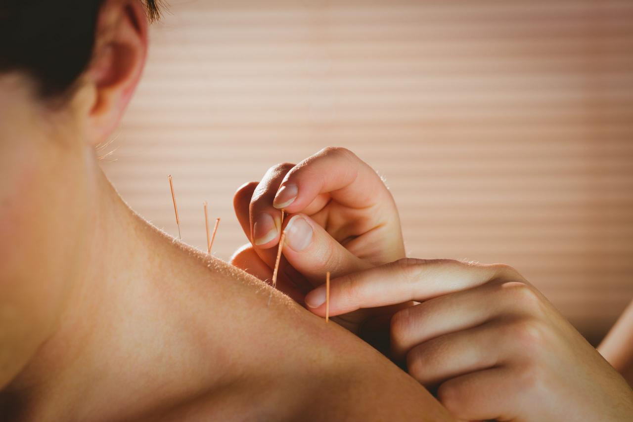 Acupuncture Treatment - Professional Service